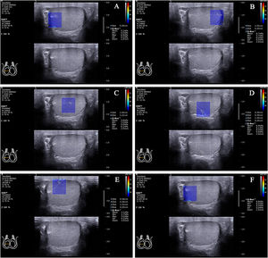 The locations of the Q-Box™ in the standard transverse axis view of the rete testis at the mid-lateral edge of the right testicle. The location of the Q-Box™ (A) is testicular parenchyma 2mm from the rete testis at the same level as the rete testis. The location of the Q-Box™ (B) is testicular parenchyma 2mm from the testicular capsule at the same level as the rete testis. The location of the Q-Box™ (C) is testicular parenchyma at half of the distance from the rete testis to the testicular capsule at the same level as the rete testis. The location of the Q-Box™ (D) is testicular parenchyma 2mm from the testicular capsule on the line that formed approximately 45° below the horizontal line of the rete testis. The location of the Q-Box™ (E) is testicular parenchyma 2mm from the testicular capsule on the line that formed approximately 45° above the horizontal line of the rete testis. The location of the Q-Box™ (F) is the rete testis.