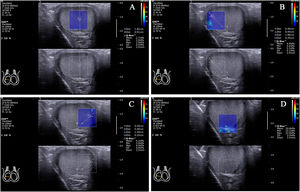 The locations of the Q-Box™ in the standard transverse axis view of the rete testis at the middle zone of the posterior lateral edge of the right testicle. The location of the Q-Box™ (A) is testicular parenchyma at half of the distance from the rete testis to the testicular capsule on the vertical line of the rete testis. The location of the Q-Box™ (B) is testicular parenchyma 2mm from the testicular capsule on the line that formed approximately 45° to the right side of the vertical line of the rete testis. The location of the Q-Box™ (C) is testicular parenchyma 2mm from the testicular capsule on the line that formed approximately 45° to the left side of the vertical line of the rete testis. The location of the Q-Box™ (D) is the rete testis.