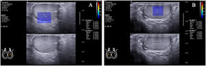 Transmediastinal arteries in two standard transverse axis views. The EMean value in the transmediastinal artery of the left testicle (A) was larger than the surrounding normal testicular parenchyma (6.30 versus 3.60kPa). The EMean value in the transmediastinal artery of the right testicle (B) was larger than the surrounding normal testicular parenchyma (13.50 versus 3.60kPa).