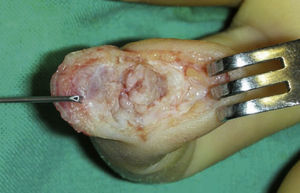 Acceso realizado en el caso 1. Nótese que la parte transversal de la incisión se sitúa justo en el límite del lecho ungueal.