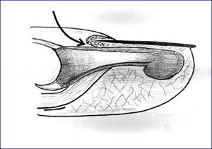 Esquema sagital para representar el acceso dorsal a la base de la falange distal entre la inserción del tendón extensor y la matriz ungueal.
