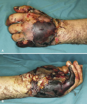 Necrosis del 5.° dedo y de la piel de la palma y el dorso de la mano.