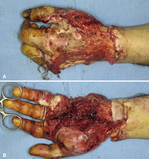 Aspecto de la mano tras el desbridamiento de la piel de la palma y del dorso de la mano y la amputación del 5.° radio.