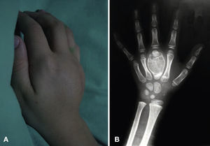(A) Recidiva de la tumoración que ocupa el dorso de la mano. (B) Radiografía en la que se observan imágenes en “pompa de jabón” y deformidad de los metacarpianos vecinos.