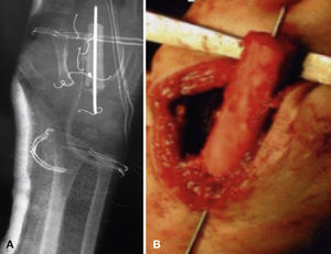 Imagen de arteriografía en la que se realiza embolización mediante coils metálicos de los múltiples vasos que irrigan la tumoración.