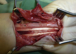 Sinovectomía de los tendones desde ulnar hacia radial evidenciándose el neuroma en continuidad del nervio mediano.