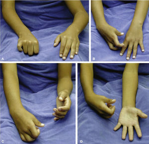 (A) Deformidad en pronación del antebrazo. (B) Para lograr la apertura del pulgar, el paciente precisa mantener la muñeca en flexión. (C y D) Supinación activa del miembro afecto comparada con el contralateral.