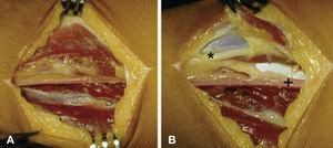 (A) Abordaje quirúrgico. (B) Identificación de arteria radial (signo suma) y del nervio radial (asterisco).