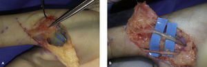 (A) SDRC tipo II en una mujer de 45 años tras cirugía de pulgar en resorte. Nervios digitales del pulgar adheridos a cicatriz quirúrgica y piel. (B) Liberación microquirúrgica de ambos nervios.