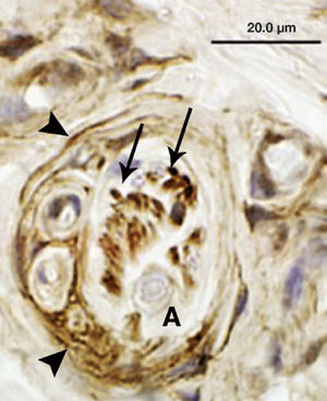 Visión de un corpúsculo de Ruffini localizado en un ligamento escafolunar con la tinción inmunohistoquímica p75. El corpúsculo de Ruffini es el mecanorreceptor más prevalente en los ligamentos carpianos, y está constantemente enviando información sobre posiciones articulares estáticas. Este mecanorreceptor se caracteriza por tener terminaciones dendríticas que se ramifican entre las fibras de colágeno (flechas completas), y por una cápsula perineural incompleta (cabezas de flechas). El axón aferente se localiza en el centro del receptor, y no tiene capacidad inmunoreactiva (A).