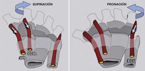 El efecto rotacional de los principales músculos motores de la muñeca se explica por la dirección que sigue el tendón desde su origen hasta la zona de inserción. El APL, ECRL y FCU son supinadores de la hilera distal, mientras que el ECU y el FCR son pronadores.