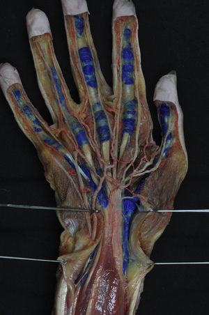 Preparación anatómica de las vainas sinoviales digitales y digitocarpianas, que se han inyectado con látex azul.