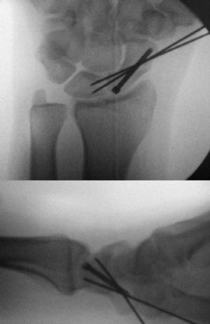 Resultado final de una fractura asociada a lesión del ligamento escafolunar.