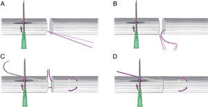 A-B. Se realiza una sutura tipo Kessler modificado en el cabo distal. C. Se introduce nuevamente la aguja en el cabo tendinoso proximal. D. Se cierra el espacio entre los dos cabos.