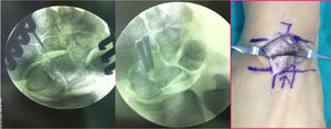 Imagen intraoperatoria de osteotomía transversa de hueso grande y síntesis de la misma con 2 tornillos canulados a compresión.
