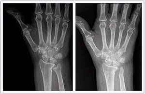 Radiología correspondiente al caso número 3: paciente afectado de artrosis radiocubital y varianza cubital minus. Se realizó técnica de Bowers.