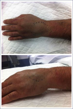 Paciente 1. Aspecto clínico de la tumoración localizada en el dorso de la mano izquierda. Se pueden determinar el tamaño aproximado y la deformidad dorsal que produce.
