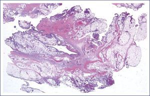 Imagen microscópica a 4 aumentos con tinción hematoxilina-eosina. Se observan fibras tendinosas infiltradas por tejido graso maduro compatible con el diagnóstico de lipoma arborescente.