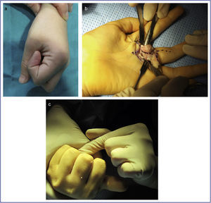 (a) Rango de movilidad prequirúrgico disminuido. (b) Lesión protruyendo de la zona palmar de la falange proximal del dedo medio. (c) Flexión completa tras la resección.