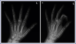 (a) Radiografía anteroposterior mostrando las irregularidades del cartílago fisario; (b) radiografía lateral de la mano mostrando un núcleo de crecimiento accesorio en la epífisis de la falange proximal.