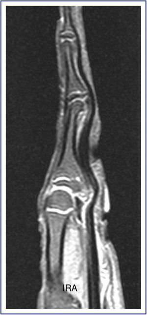 Imágenes sagitales en T1de RMN revelando el componente óseo de la lesión con una señal similar al hueso normal de la falange y el componente cartilaginoso de la misma con una señal intermedia. Desplazamiento del tendón flexor por la tumoración.