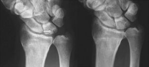 Radiografía anteroposterior de muñeca: la flecha indica una imagen radiolúcida en el borde proximal y cubital del semilunar característico del pinzamiento cubitocarpiano (izquierda). Evidente varianza cubital positiva (cúbito plus) con la muñeca en pronación con el puño cerrado en el mismo paciente (derecha). Cortesía del Christine M. Kleinert Institute for Hand & Microsurgery.