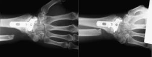 Pinzamiento (impacto) dinámico entre el radio y el cúbito tras la resección distal del cúbito. Cortesía del Christine M. Kleinert Institute for Hand & Microsurgery.