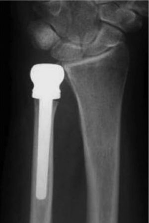 Radiografía de una reconstrucción de la articulación radiocubital distal (ARCD) con una hemiartroplastia. Cortesía del Christine M. Kleinert Institute for Hand & Microsurgery.