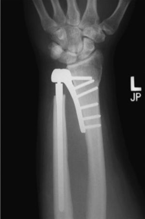 El resultado de una artroplastia total de la articulación radiocubital distal (ARCD) con una prótesis modular semiconstreñida con polietileno de ultraalto peso molecular. Antes del reemplazamiento protésico, el paciente había sido intervenido de una escisión del cúbito distal y presentaba dolor al movilizar la muñeca y el antebrazo desde hacía 2años. El seguimiento 5años después de la colocación de la prótesis reveló una pronosupinación completa del antebrazo, así como un completo arco de movilidad tanto de la muñeca como del codo sin dolor. El paciente retomó su previo trabajo 4meses tras la cirugía. Cortesía del Christine M. Kleinert Institute for Hand & Microsurgery.