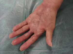 Aspecto de la mano a los 92días de iniciarse el tratamiento corticoide. Se observa la completa epitelización de la lesión.