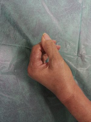 Flexión de los dedos a los 92días de iniciarse el tratamiento corticoide.