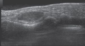 Sección sagital de ecografía de un tumor de células gigantes de la vaina tendinosa situado en la región volar de la falange proximal.