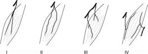 Tipos de inervación, según Taylor et al.4. Tipo I: ramo único no ramificado entrando al músculo; tipo II: ramo único ramificado entrando al músculo; tipo III: ramos múltiples procedentes de un mismo nervio; tipo IV: ramos múltiples procedentes de distintos nervios.