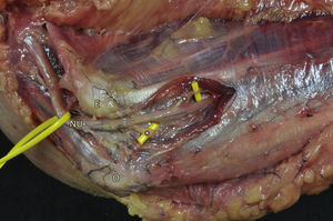 Preparación anatómica que muestra el nervio ulnar en el punto en que se separan sus ramos motores para el FCU.Asteriscos: ramos motores; E: epicóndilo medial (epitróclea); NU: nervio ulnar; O: olécranon.
