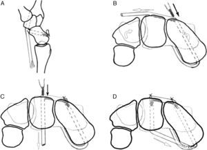 Representación esquemática de la plastia desde una perspectiva de distal a proximal. A) Un injerto de palmar mayor de base distal es pasado a través del polo distal del escafoides de volar a dorsal. B) El injerto tendinoso es llevado en dirección cubital y anclado en el túnel óseo del escafoides de dorsal a palmar. Un canal es creado en la parte dorsal del escafoides y semilunar. C) El injerto tendinoso es pasado a través del túnel creado en semilunar. El espacio EL es reducido y un segundo tornillo interferencial es colocado en semilunar de dorsal a volar. La tensión en la plastia con este segundo tornillo reduce el intervalo EL y dará estabilidad primaria. D) Finalmente, el injerto tendinoso es pasado ventralmente de semilunar a escafoides y fijado sobre sí mismo en la entrada en escafoides.