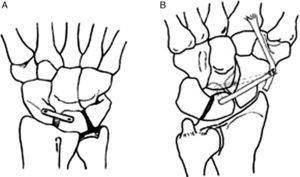 Vista de la posición final de la reconstrucción dorsal A) y ventral B) del ligamento EL.
