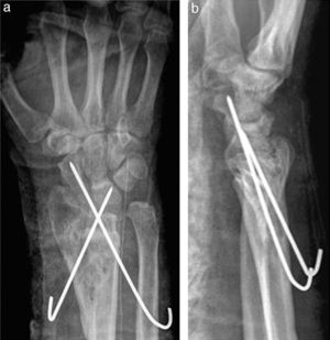 a y b) Radiografía anteroposterior y lateral postoperatoria de artrodesis RSL sintetizada con 2 agujas de Kirschner: radiosemilunar y radioescafoides.