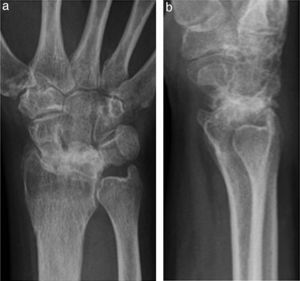 Imagen de radiografía anteroposterior (a) y lateral (b) en paciente intervenido de artrodesis RSL con consolidación satisfactoria.