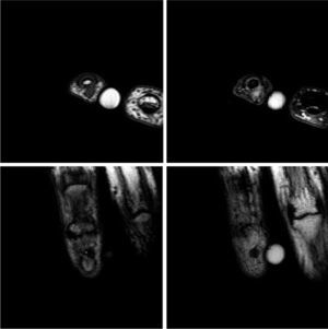 Estudio RM de la lesión. Arriba: cortes axiales, secuencias T1 TSE y T2 SPAIR, respectivamente. Abajo: cortes coronales, secuencias T1 TSE. Se observa un nódulo situado en el pulpejo del dedo, a la altura de la porción central de la falange distal y sin aparente relación con la articulación interfalángica. Este nódulo está bien delimitado y mide 3mm de diámetro.