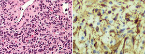 Estudio histológico de la lesión. A la izquierda, tinción hematoxilina-eosina que muestra células de aspecto mioide, sin atipia ni actividad mitótica y con tendencia a la disposición perivascular concéntrica. A la derecha, inmunohistoquímica positiva para h-Caldesmon.