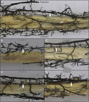 Preparaciones anatómicas de las arterias nutrícias de 5 peronés, indicadas con una flecha. Puede observarse su pequeño calibre relativo a los vasos periósticos que las rodean.