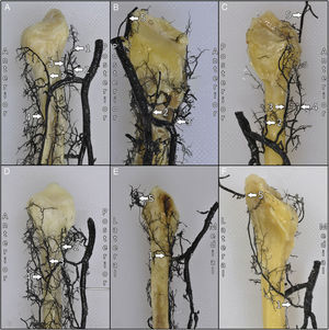 Preparaciones anatómicas de la distribución de los vasos que nutren la epífisis proximal de 6 peronés. 1: Arteria recurrente tibial posterior; 2: arterias longitudinales; 3: arteria recurrente tibial anterior; 4: arteria recurrente tibial anterior; 5: arteria inferolateral de la rodilla.