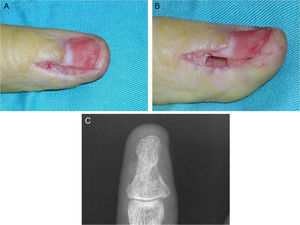 A-C: escisión ungueal y abordaje lateral en un paciente con invasión ósea en el borde cubital del pulgar.