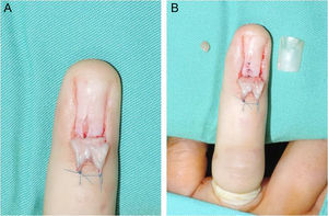 A y B: tumor glómico en tono pálido.