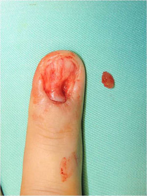 Tumor glómico en tono sonrosado.