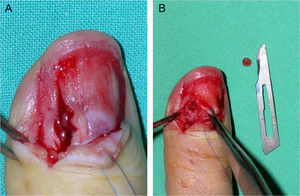 A y B: tumor glómico en tono rojo intenso.