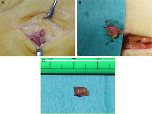 A-C: tumores glómicos extradigitales; A) tumor en la palma de la mano; B) tumor en la zona interna del codo; C) el tumor del codo tras su exéresis.