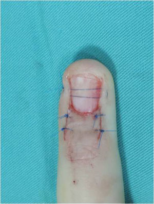 Reposición de la uña en la paciente de las figuras 2A,B y 7 para proteger la sutura del lecho ungueal y favorecer el tratamiento postoperatorio.