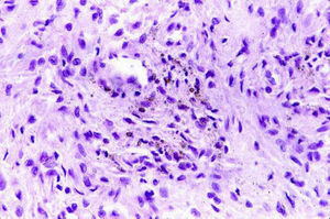 Imagen microscópica (H-E) de la muestra del caso 1 en donde podemos ver fibras de colágeno y fibroblastos rodeados de matriz mixoide, con pequeños vasos.