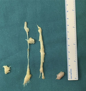 Muestra de las piezas extraídas del caso 2, en donde se observan las 2 masas extirpadas, así como la sinovitis del túnel, de aspecto semejante.